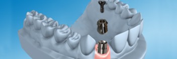 REVOIS® compact implant line